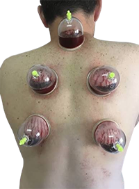 Cupping Therapy (Hijjama) at Home in Gurgaon