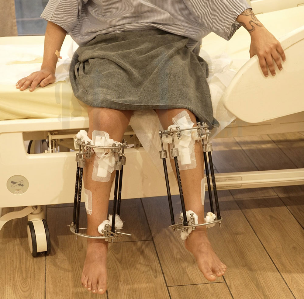 CARENURSE Height Increase Surgery in Gurgaon India