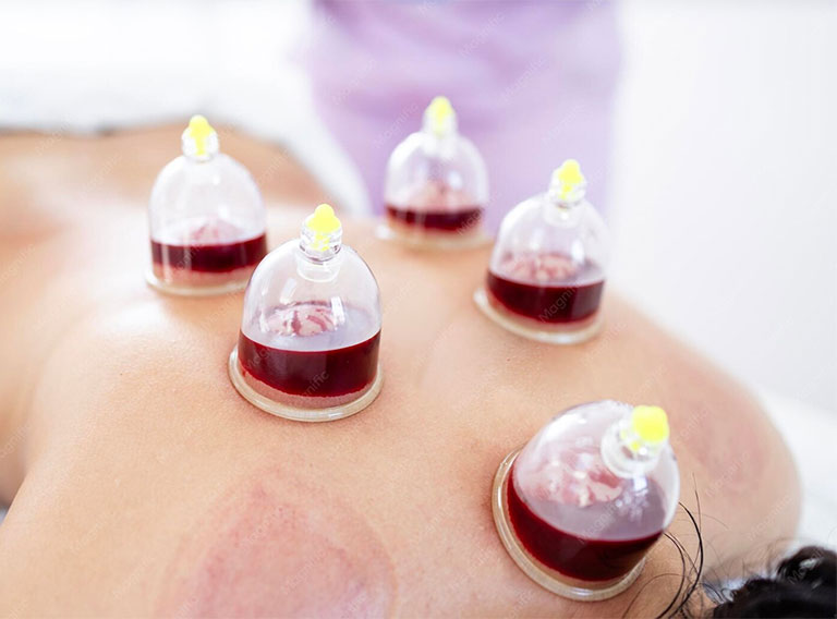 Hijama Therapy Near Me at CareNurse in Gurgaon