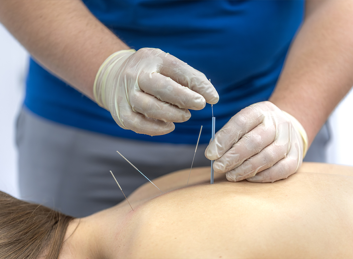 Dry needling treatment on the shoulder