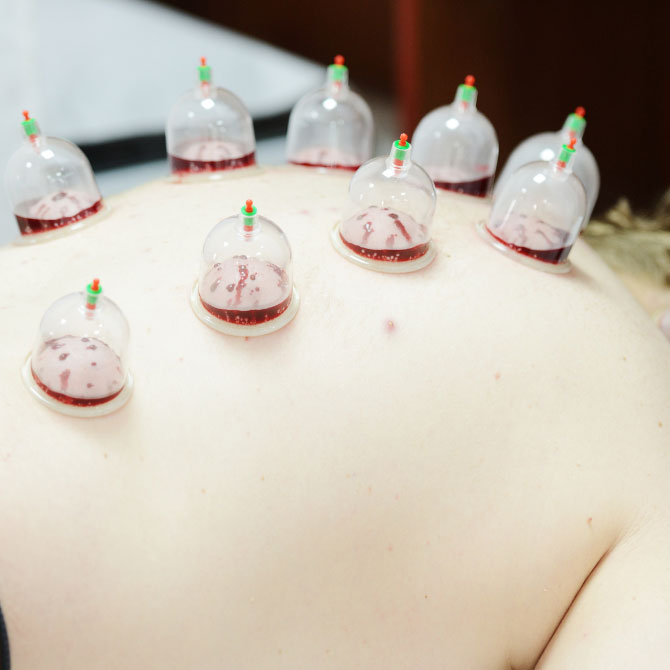 Sunnah Hijama Therapy in Gurgaon